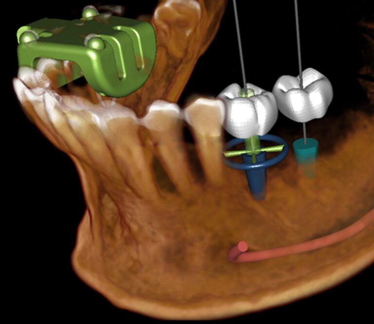 Virtual surgical planning